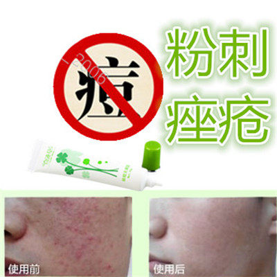 正品去除面部男女修复闭合性豆豆青春痘痘痤疮酒糟鼻前胸后背额头