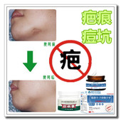 祛疙瘩修复增生性凸疤手术缝针剖腹产伤疤痕印体质抓伤摔伤撞伤液