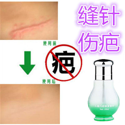 祛除烟烫剖宫产体质去缝针凸起剖腹产刀伤疤痕印疙瘩纹身手术摔伤