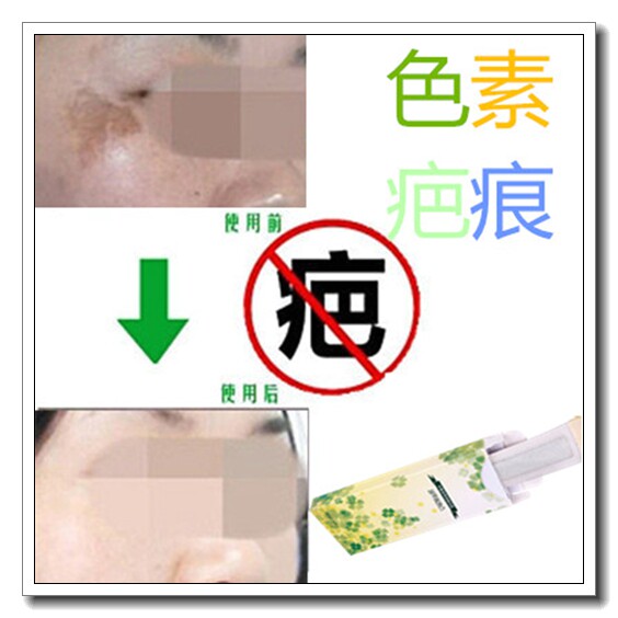 去除黑色素沉淀沉着回流去脸部痘印痘疤痕霜雀斑液点斑后修复消印