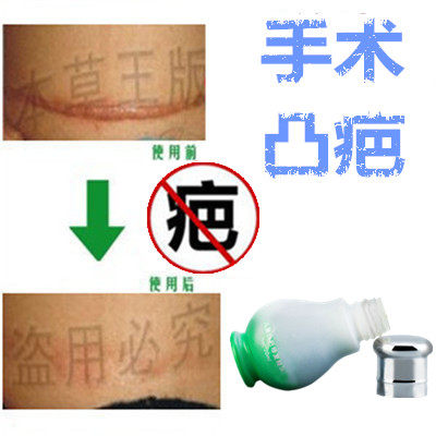 祛男女增生性凸起去除手术后剖宫产刀伤疤痕印液抓伤摔伤撞伤疤膏