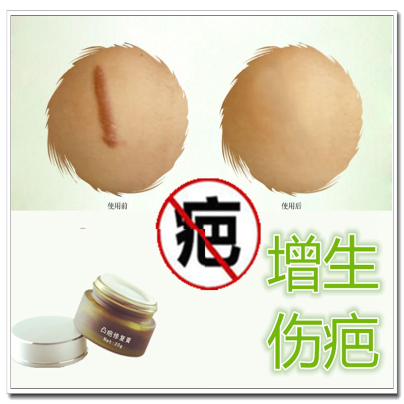 儿童脸面部祛巴膏除手术疤凹凸伤疤痕灵修复贴霜抑疤灵正品黑色素