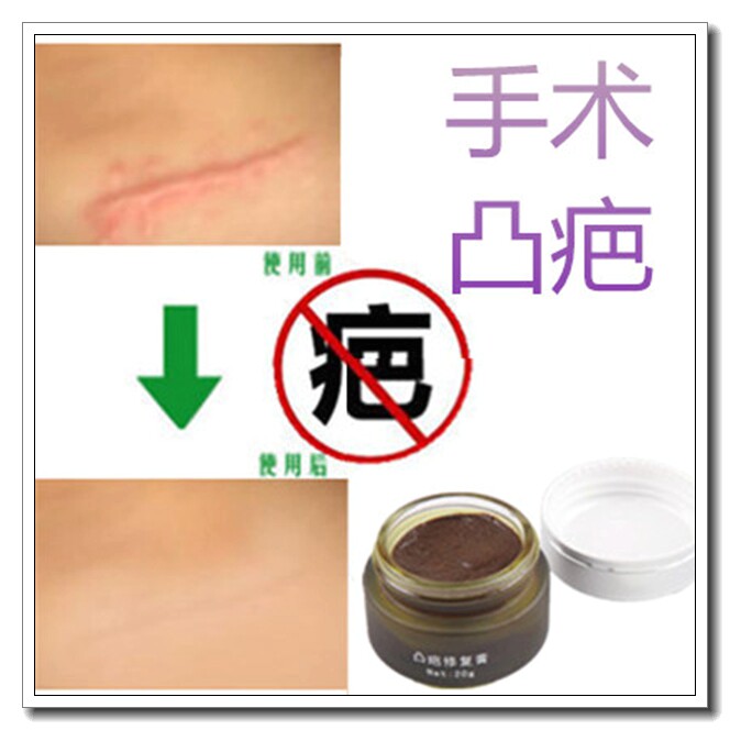 祛除脸部烟疤易消正品去色沉黑色素手术剖腹产后增生贴疤痕平软膏