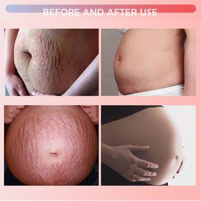 Stretch Mark Vanishing Cream Repair Anti-Wrinkle Anti-Aging