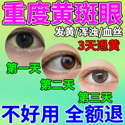 眼白清澈去黄眼睛发红血