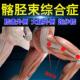 髂胫束综合症大腿外侧膝盖外侧疼痛下蹲困难腿疼专用膏贴舒筋活络