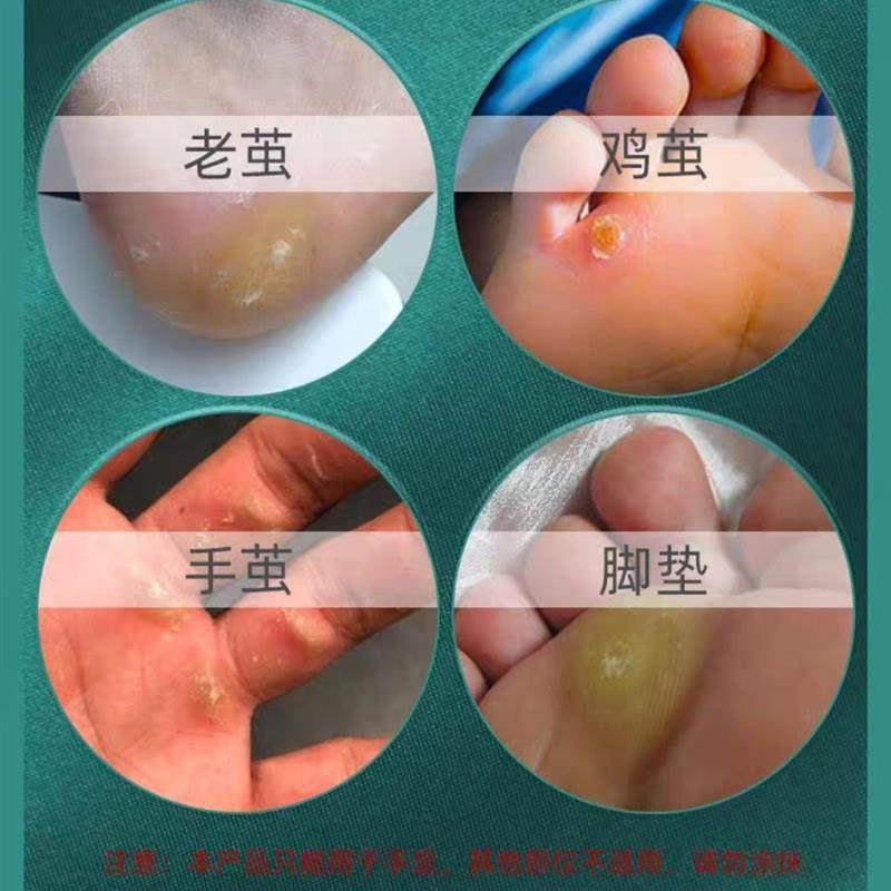 创智远老茧去除软化剂脚清茧去死皮关节茧老茧脚底手茧肉刺鸡茧去,保健用品,皮肤消毒护理（消）,淘宝优惠券,粉丝福利购,淘宝优惠卷