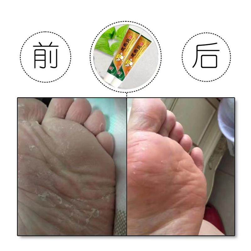 紫西康足乐爽抑菌乳膏本草抑菌身上痒抑菌膏【买二送一】,保健用品,皮肤消毒护理（消）,淘宝优惠券,粉丝福利购,淘宝优惠卷