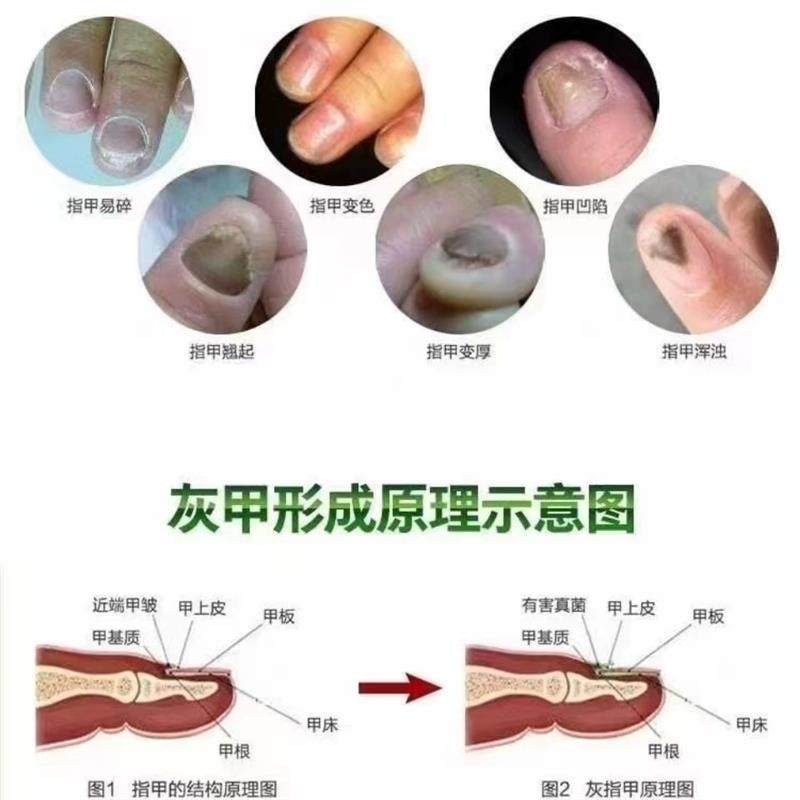 灰指甲用液甲沟炎增厚亮甲去除抑菌液脱甲软甲膏修脚套盒买3送1,保健用品,皮肤消毒护理（消）,淘宝优惠券,粉丝福利购,淘宝优惠卷
