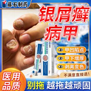 银屑甲指甲剥离凹凸不平专用病甲修复搭膏药贴空甲变白发黄增厚YJ