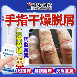 手指关节癣手癣膏真菌感染湿疹脱皮干裂增厚脱屑手足癣鹅掌风YU