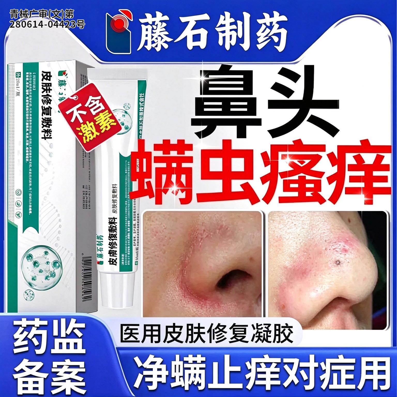 鼻子螨虫脸部去药监备案膏脸上清洁酒糟鼻头毛囊炎祛痘面部除螨YJ