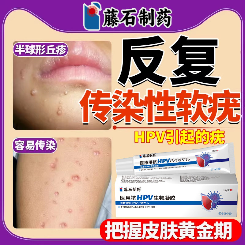 可搭配病毒性传染性软疣幼儿童医用镊子夹子刮勺水瘊子软尤药膏LJ