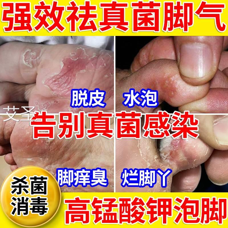 医用高锰酸钾泡脚粉末片外用杀菌烂脚丫去真菌药包脚气止痒脱皮