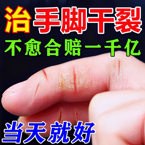 【200%全愈】冶手裂的药膏防干裂