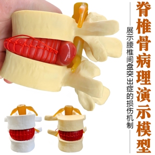 医学人体腰椎间盘受压突出演示模型脊柱脊椎关节骨骼病理侧压模型