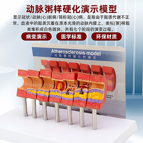 动脉粥样硬化模型血管血栓栓塞