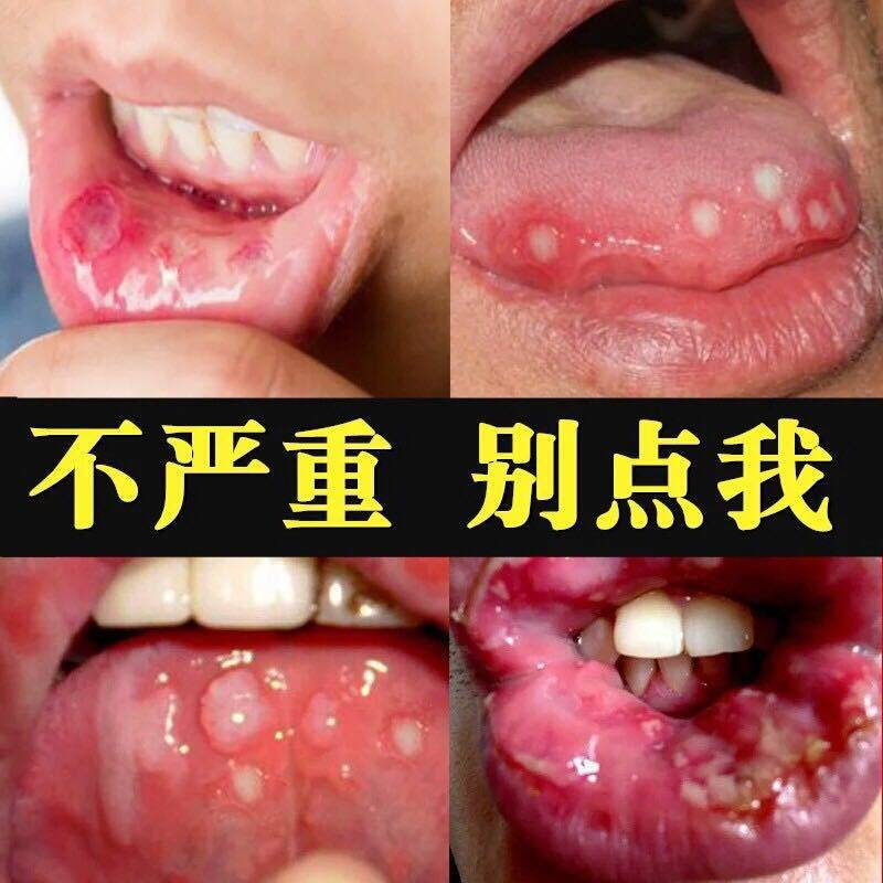 蜂胶口腔白点喷剂30ml异味口苦口臭口气清新剂嘴角烂裂脱皮溃疼菌