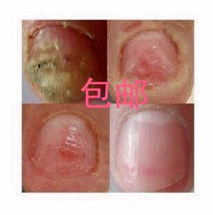 灰康脚趾专用灰灵清净去厚脚指甲增厚变黄神器脱软甲膏液