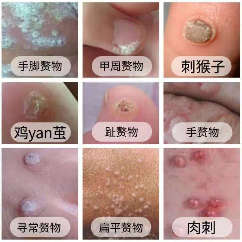 老牌子七叶足尤清威祛赘膏足部老茧瘊子鸡眼刺猴肉刺鸡茧肉粒疙瘩