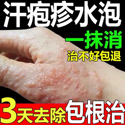 汗疱泡疹手上起小水泡一瓶就够