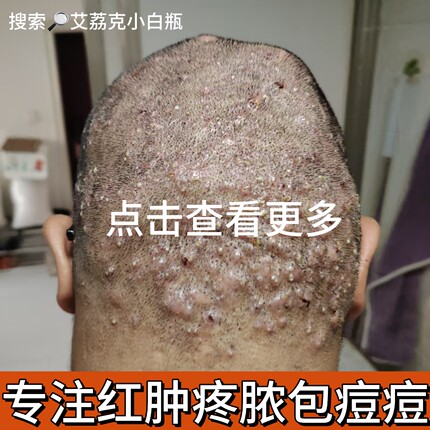 头上长痘痘毛囊炎中药 头皮痘痘有疙瘩毛囊炎金黄葡萄球菌感染