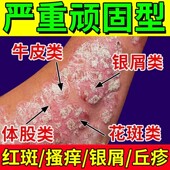 香港牛藓王牛皮药膏藓头皮股银去屑病皮肤杀菌专用止痒正品 神器癣
