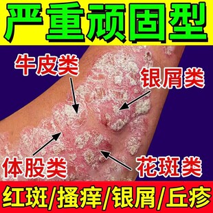 香港牛藓王牛皮药膏藓头皮股银去屑病皮肤杀菌专用止痒正品神器癣