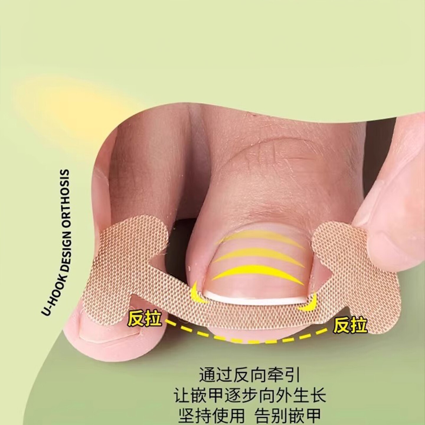 甲沟矫正器贴片纠正甲垫灰贴透气