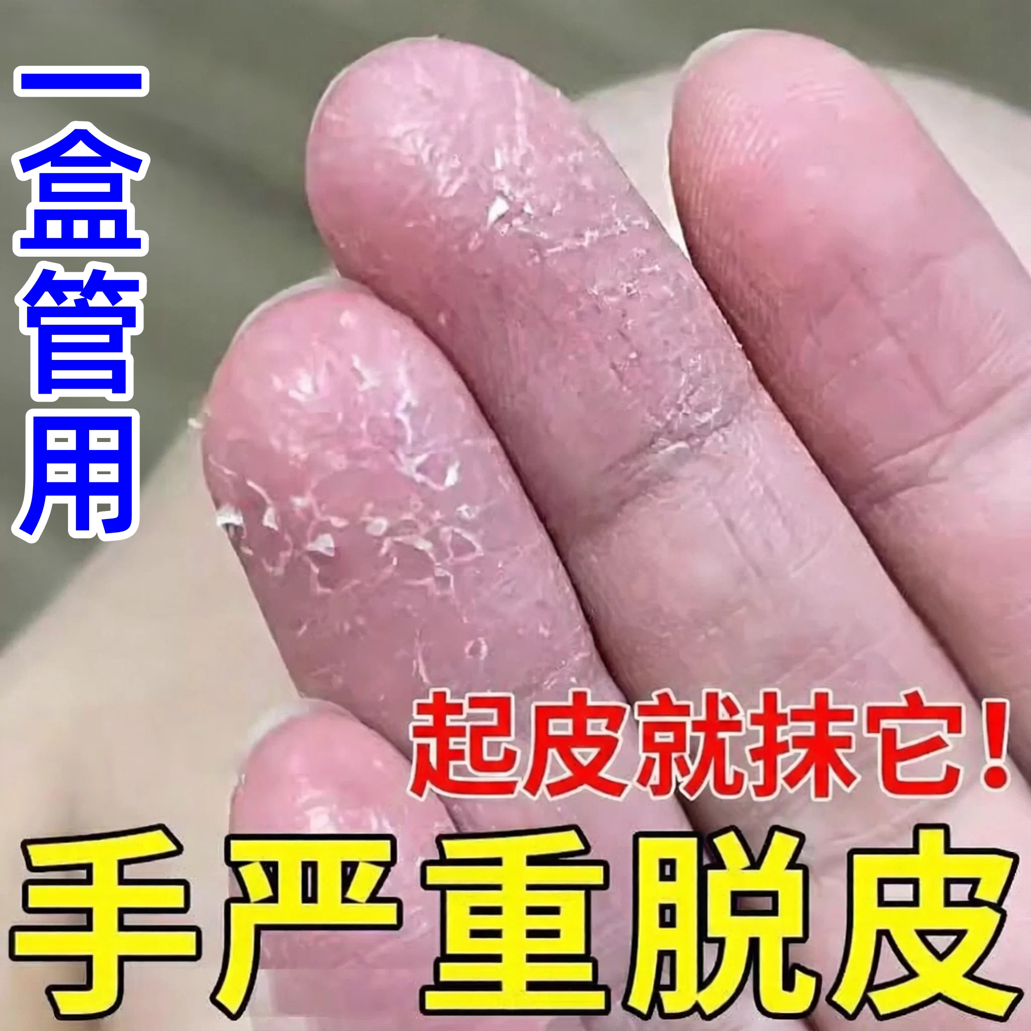 治手脱皮药膏手指头脱皮手足脱皮膏手上起皮干燥蜕皮严重手指手掌