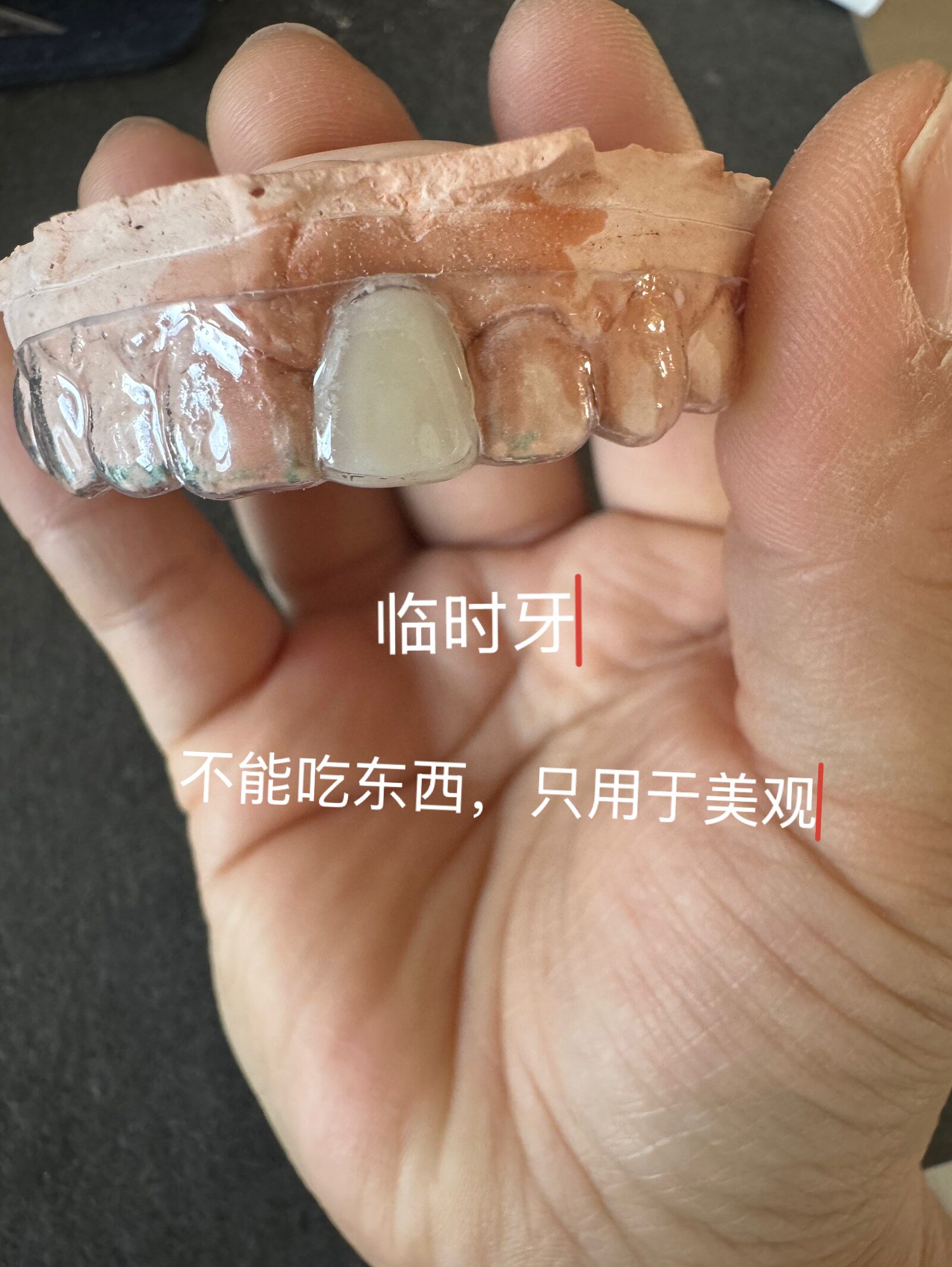 门牙假牙遮丑仿真临时修复临时牙前牙遮丑种植后简易假牙口腔
