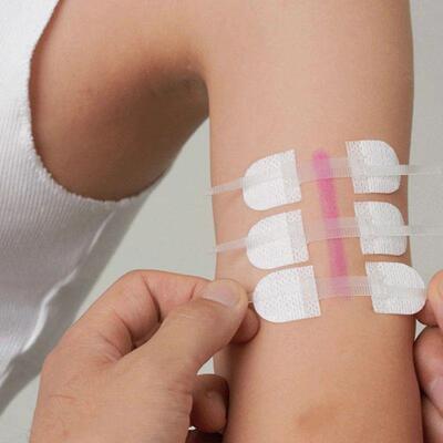 Band-Aid Zipper Tie Wound Closure Patch Hemostatic Patch Wou