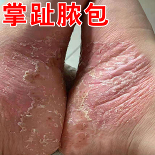 掌趾脓疱病专用膏掌跖角化症手脚干裂蜕皮角皮症掌跖脓包病