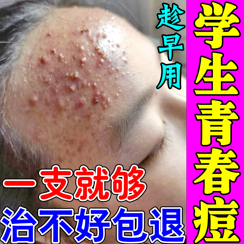 青春痘祛痘药膏男女学生青少年额头长上长痘痘闭口粉刺去豆豆正品