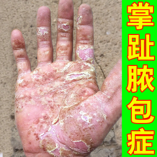 掌趾脓疱病症专用膏掌跖脓包手脚脓包角化病脱皮干裂症