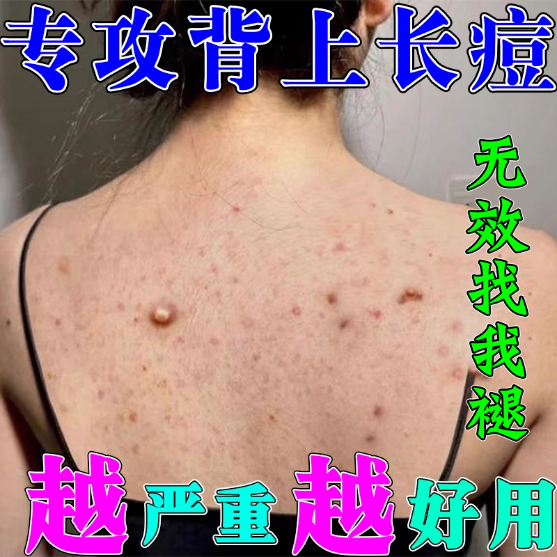 去除满背毛囊炎痘痘修复乳膏
