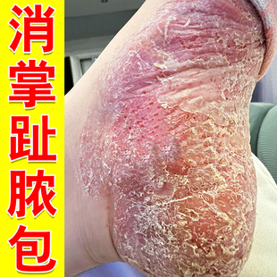 掌趾脓疱病掌跖角化症手脚干裂蜕皮角皮症掌跖脓包病专用膏