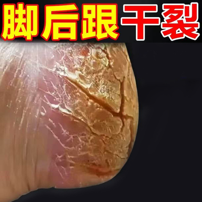 脚裂脚后跟干裂起硬皮足跟开裂脱皮修复霜