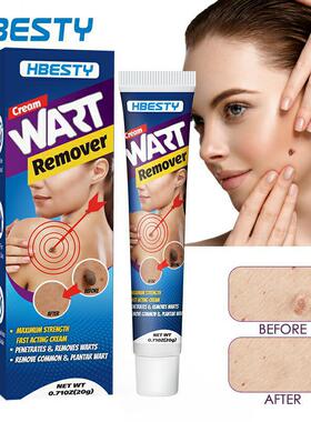 HBESTY Wart Remove祛wart膏 皮肤wart斑痣鸡眼无痕护理膏