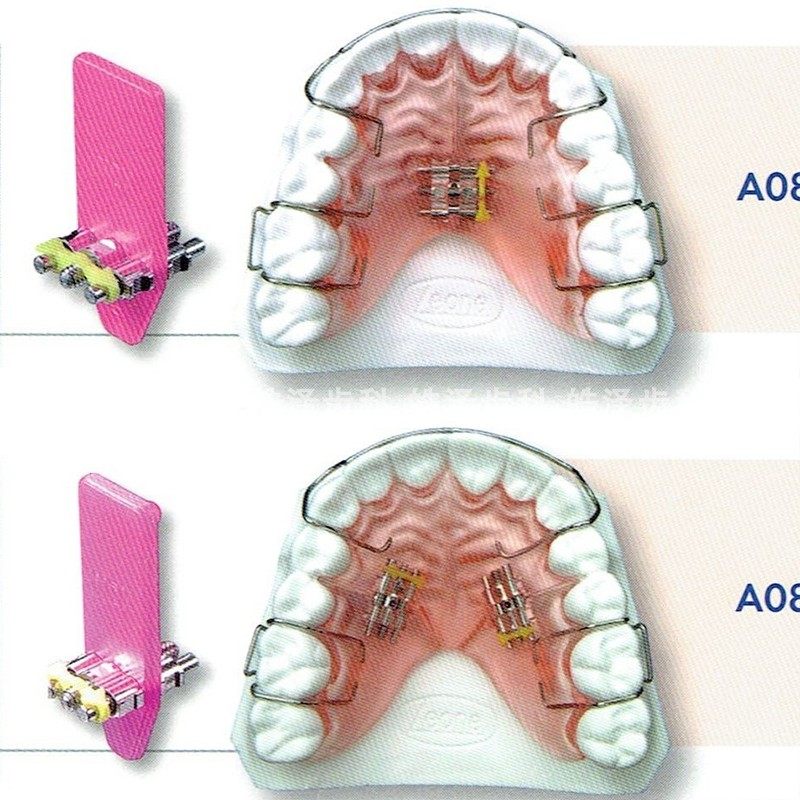 leone正畸螺丝活动矫治器固定扩牙弹簧快速扩弓器在线定制矫正器