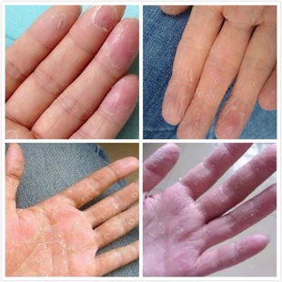 治手痒水泡开裂脱皮皮肤外用抑菌膏手气反复干燥脱皮烂脚丫止痒膏