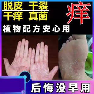 治手脚脱皮膏脚底干燥开裂手起水泡蜕皮皮肤抑菌止痒药手气反复药