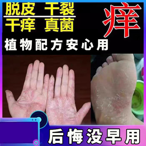 治手脚脱皮膏脚底干燥开裂手起水泡蜕皮皮肤抑菌止痒药手气反复药