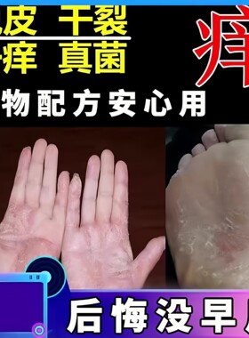 治手足起皮脱皮药皮肤抑菌止痒膏