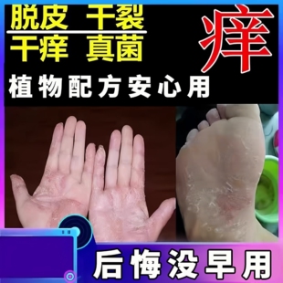 治手脚小水泡脱皮药脚底蜕皮干燥开裂皮肤外用药抑菌止痒膏反复药