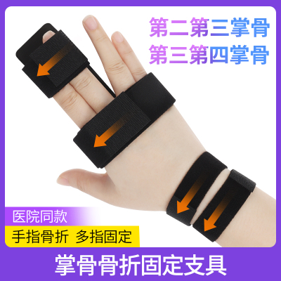 医用第二第三第四掌骨骨折固定器