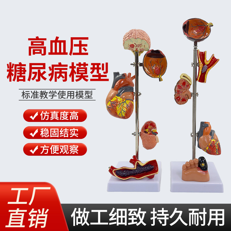 蓝蝶模型高/血压糖/尿病医学教具