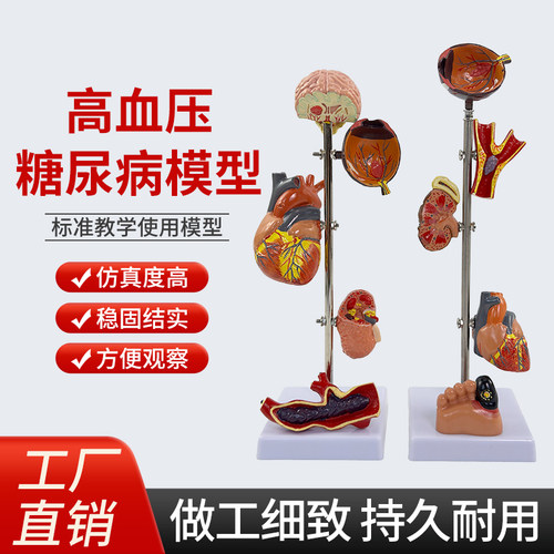 蓝蝶模型高/血压糖/尿病医学教具