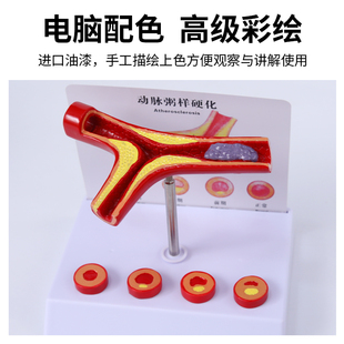 人体粥样支脉硬化模型 形成血栓  血液科 硬化动脉