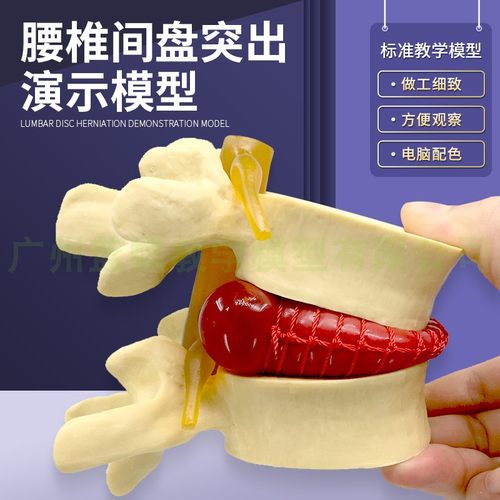 蓝蝶模型腰椎间盘脊柱突出演示